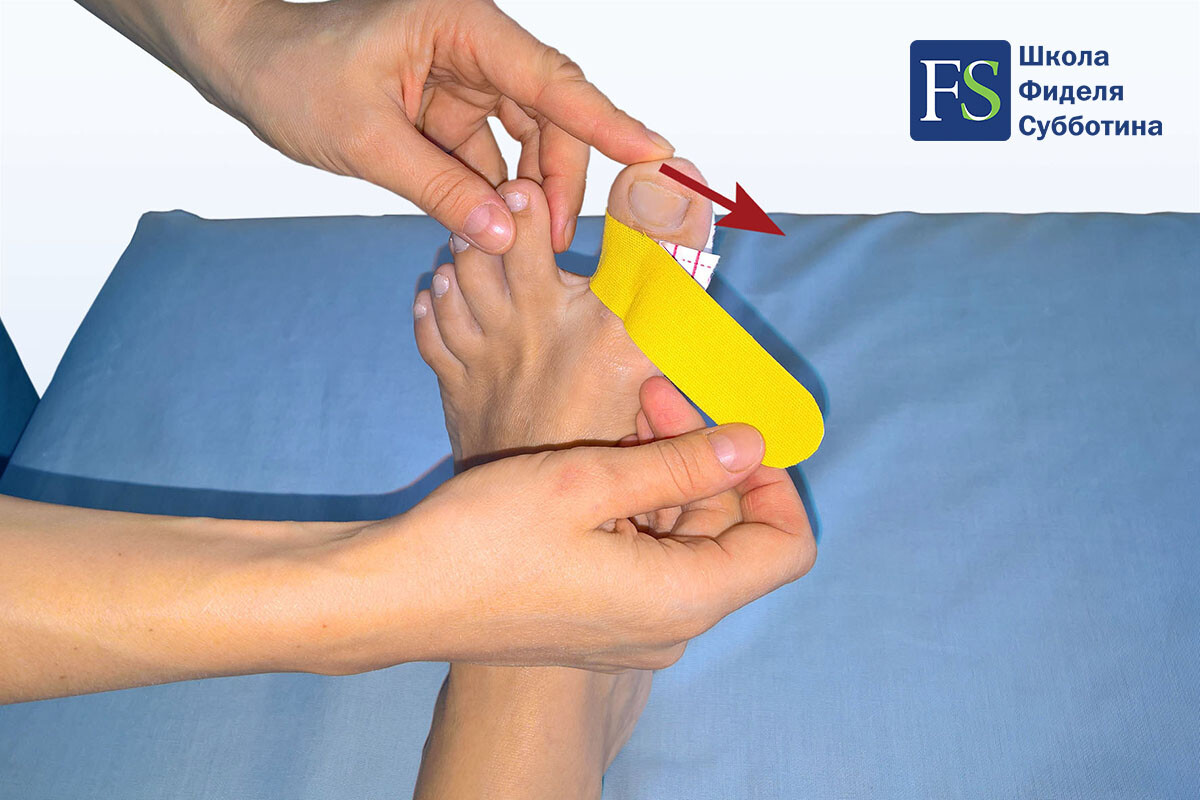 Статодинамическое тейпирование стопы при Халюс Вальгус (Hallux Valgus) - 2 Статодинамическое тейпирование стопы при Халюс Вальгус (Hallux Valgus) - 2